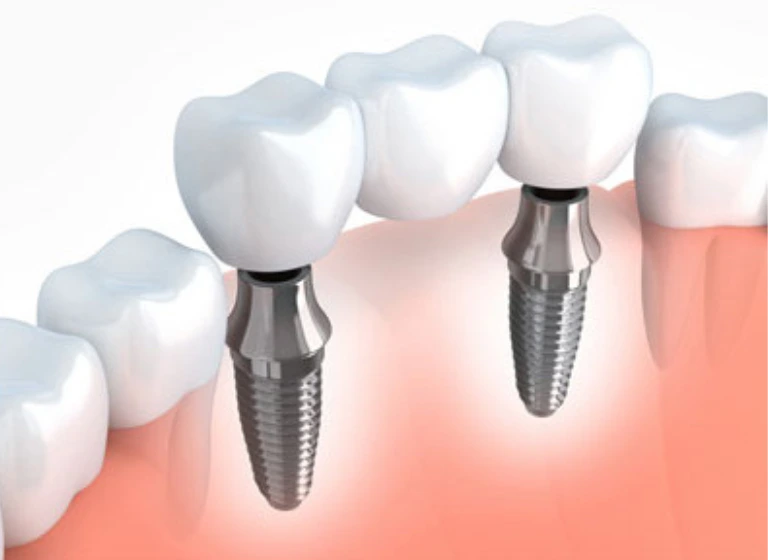 IMPLANTS