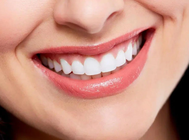 SMILE MAKEOVER